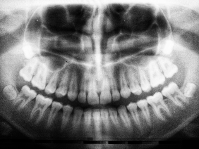 Soñar con dientes, ¿Qué significa?